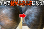髪が生えたよ!!「フィナステリド」と「ミノキシジル」を使った3ヶ月レビュー｜AGA（男性型脱毛症）治療薬の感想・口コミ