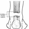 Achilles Tendinitis