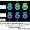 開発中のアルツハイマー病治療薬はどうなった？