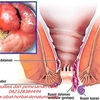 Cara Menghilangkan Benjolan Ambeien Wasir Stadium 3 Tanpa Operasi