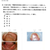 118回歯科医師国家試験【118A-33】義歯：口蓋の修正