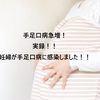 【妊婦が手足口病に感染！】妊娠８か月に手足口病になりました！手足口病による胎児への影響など（ブログ体験談）