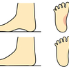 足の裏の疲れ、もしかして扁平足が原因かも？