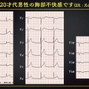 ECG-243：answer