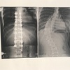 #04 脊柱側彎症の手術