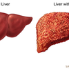 肝硬変患者思ったより多い
