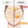 副鼻腔炎について