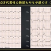 ECG-245：60才代男性。胸部のもやもや感でER受診です。