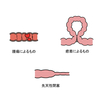 腸閉塞に関する雑学