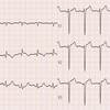 ECG-148：answer