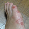 手足口病　治ったみたいです。