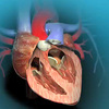 What is the Heart Valve Replacement, Symptoms and Process?