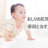 【育児】赤ちゃんのおしりの肌荒れの原因と治す方法