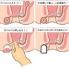 肛門周囲膿瘍で肛門二つになって片方タンポンで蓋をされた話