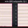 ECG-364：Wide QRS tachycardiaに慣れましょう！ = 心電図検定試験：傾向と対策 Q.012=　Q:1-3です