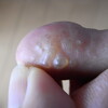  汗疱状湿疹（足の指）その後４