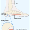 Heel Pain