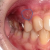 「歯ぐきから膿がでている、なんとか歯を残したい」～大きな病変がある歯を外科治療で保存できるか～