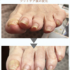 【訪問看護でフットケア】爪が切りにくく困っていた方