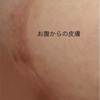 【乳がん】放射線治療3回目　皮膚が...