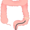 血便が出たら要注意！大腸カメラ検診を実際にやってみた。