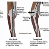 反張膝を直すと、太腿の前張りが減りやすい　②