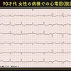 ECG-224：90才代女性。徐脈でβ-blockerを休止した患者の波形が、おかしなことになりました。