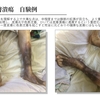 鬱滞性皮膚炎・潰瘍を科学する３