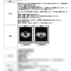 【大腸の話】希少がんの神経内分泌腫瘍（NET）ほぼ確定、入院手術即確定