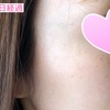 ホクロ&シミが取れてスッキリ肌♩♩