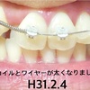 大人の歯列矯正 12 〜 前歯の経過報告 〜