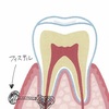歯茎のおできをあなどるな　サイナストラクト（フィステル）