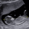第二子妊娠: 12w0d 胎児スクリーニング検査