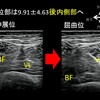 膝関節屈曲制限を考える