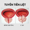 Cách chữa bệnh u xơ tuyến tiền liệt