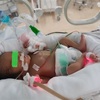 新生児遷延性肺高血圧  