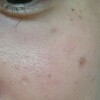 【ほくろ除去】ほくろにレーザーを当てて9ヶ月経過