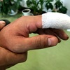ウツボに噛まれて8針縫ったダンナ、その後の経過。