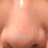【鼻尖形成・鼻翼縮小】手術前後の比較、正面