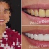 Ưu điểm của răng toàn sứ cercon