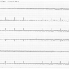 ECG-083：answer