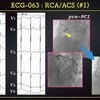 コラム-082：ACS  RCAとLCX 責任病変の違いを、また考えてみましょう 2/2