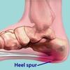 Preventing Posterior Calcaneal Spur