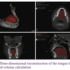 異なる歯骨格パターンにおける舌の体積の3次元評価-コーンビームCT研究 