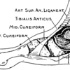 Posterior Tibial Tendon Dysfunction Cause And Treatment