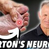 What Causes Mortons Neuroma