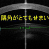 緑内障発作の予防と治療