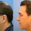 Detailed Notes On Hairtransplantphoenix.Net