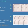 【コラム-131：心電図検定試験-2A合格から1B合格までシリーズ001：心房細動(その3)-いろんな心房細動の波形です】