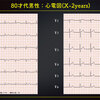 ECG-323：70才代女性。胸部不快感の出現でERを受診しました。